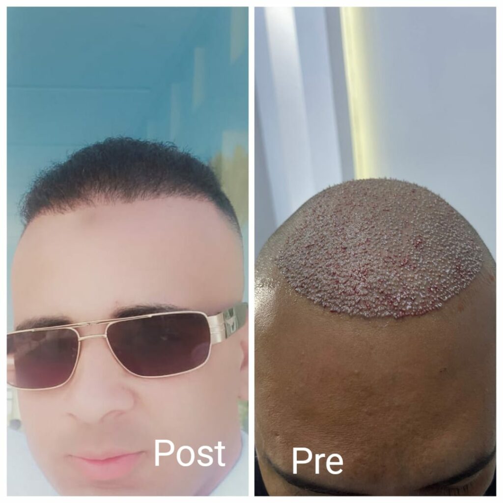 زراعة الشعر في مصر